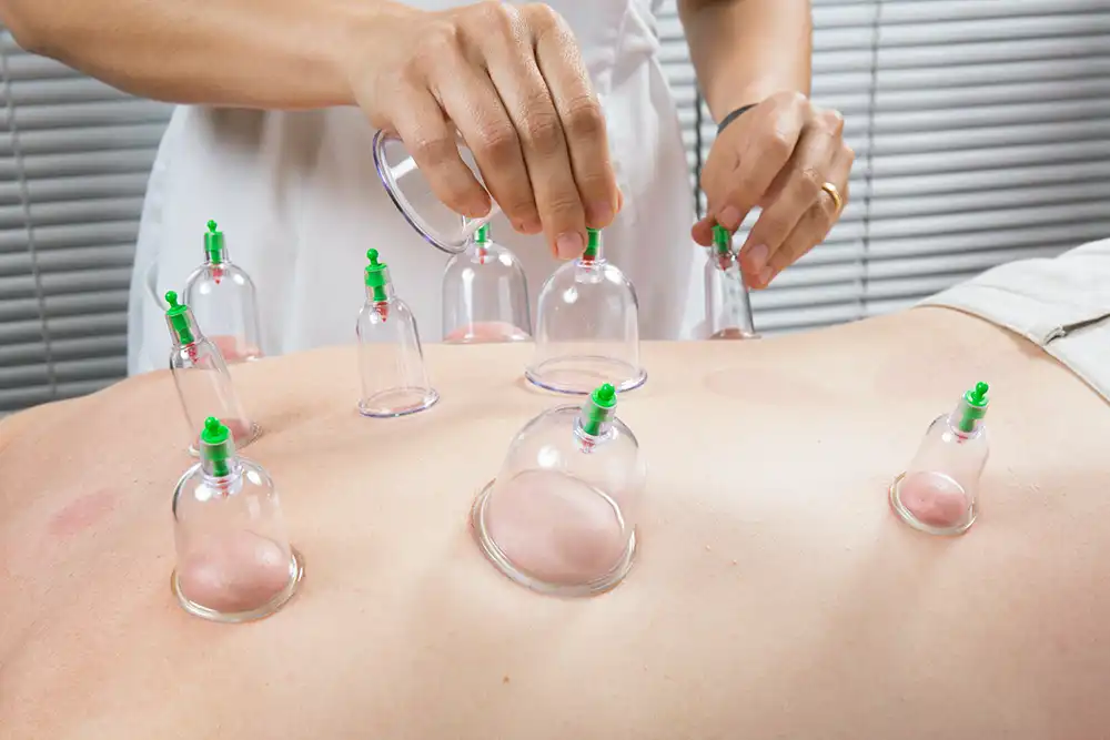 Cupping