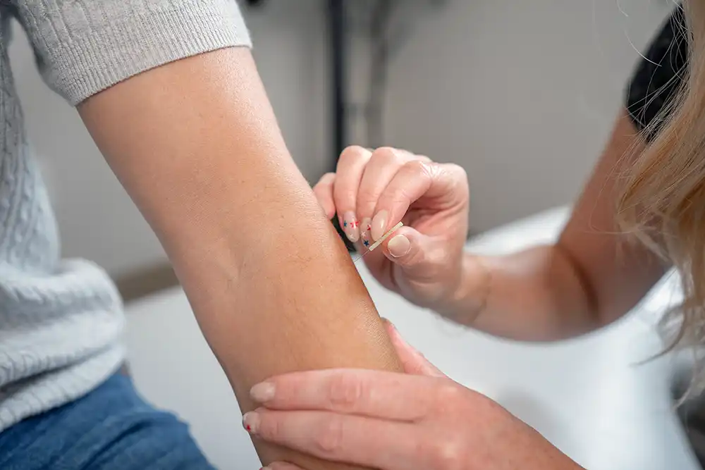 Close-up of dry needling on a patient's shoulder